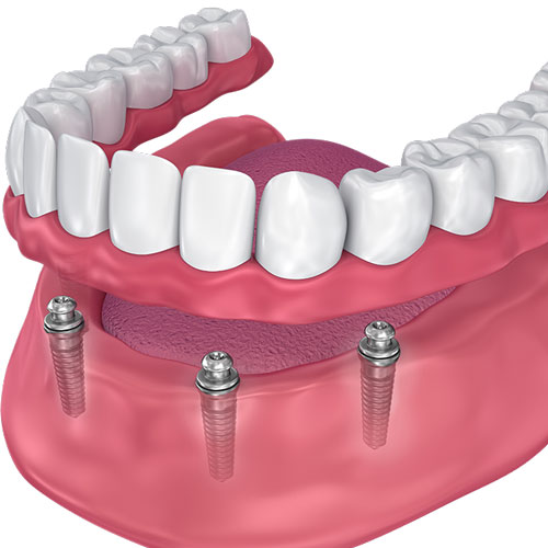 Dentures