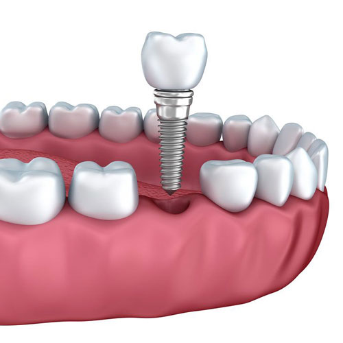 Dental Crown
